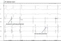 lv thrombus bridging